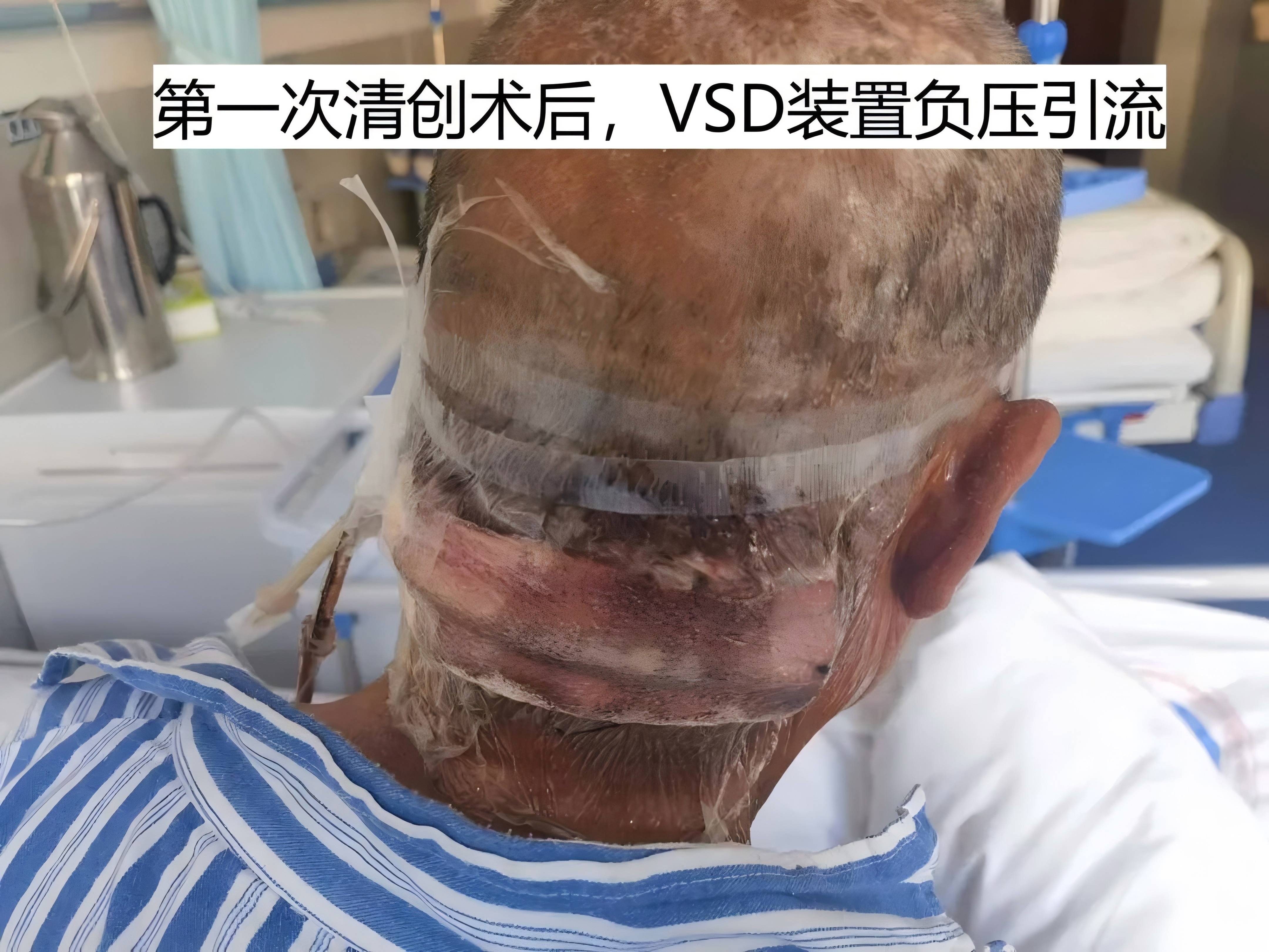 vsd第一次清创(1).jpg