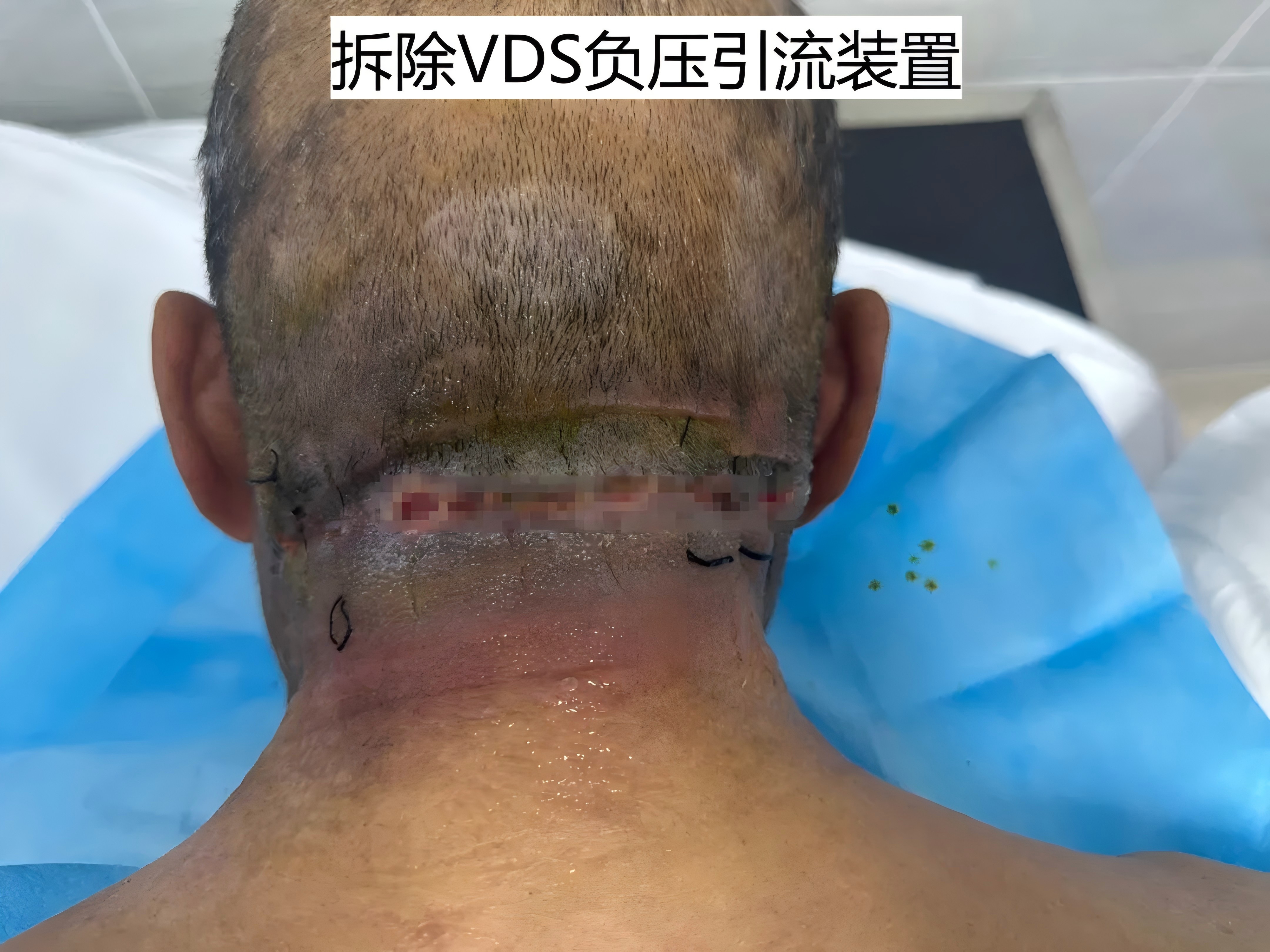 vsd拆除.jpg
